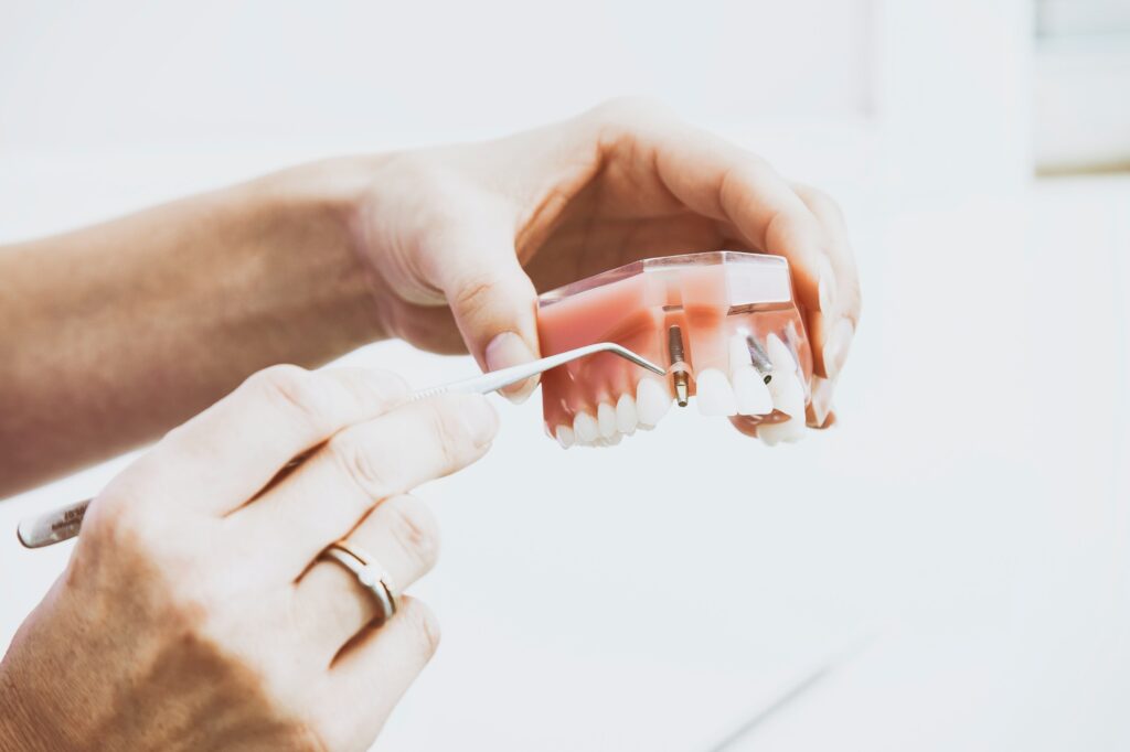 Implants dentaires : combien de dents peuvent-ils remplacer ?
